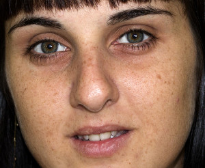 Ojeras de dos tonos