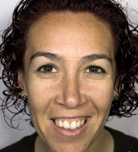 Ojeras sutiles